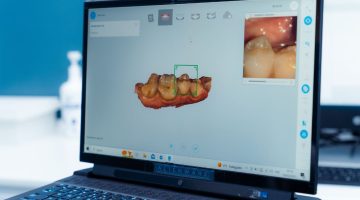 Scanner intraorale